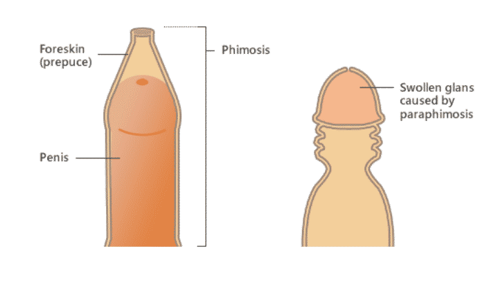 A diagram of a bottle depicting Circumcision in Malaysia.
