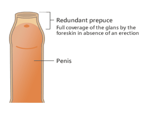 redundant foreskin explaination picture