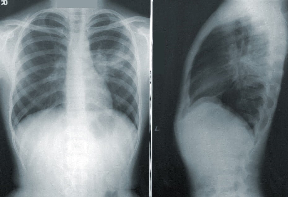 Imej xray Radiografi Konvensional dan Berkomputer