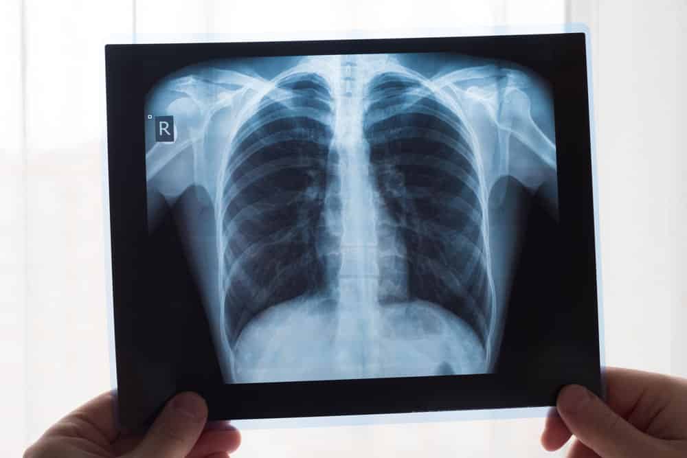 胸部の X 線写真を掲げ、従来の X 線撮影技術とコンピューター X 線撮影技術の両方の結果を示している人。
